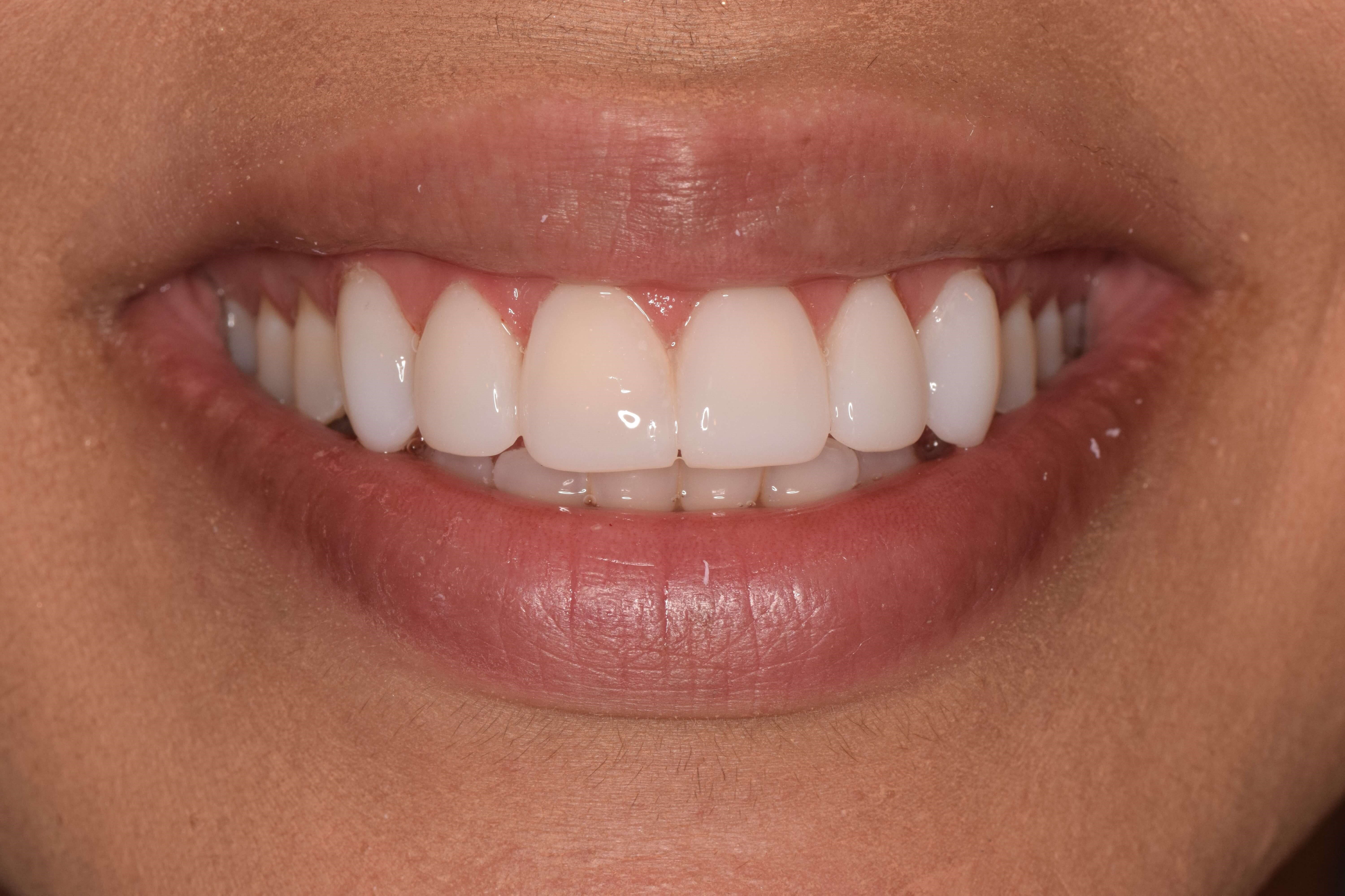 Before and After Composite Bonding & Smile Makeover Photos Before and After Composite Bonding & Smile Makeover Photos